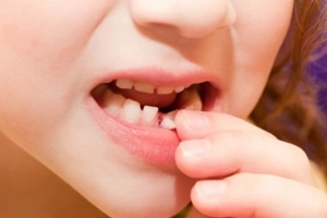 Trình tự thay răng sữa ở trẻ em