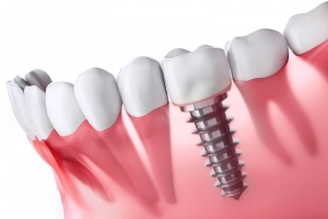 Trồng răng giả có ảnh hưởng gì không?