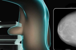 Tư thế chụp X quang tuyến vú (mammography)