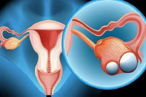 U túi noãn hoàng buồng trứng: Triệu chứng và cách điều trị
