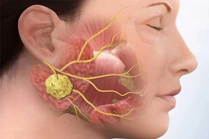 U tuyến nước bọt mang tai