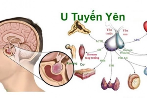 U tuyến yên tăng tiết prolactin là gì?