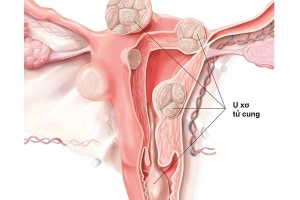 U xơ tử cung: Các trường hợp có chỉ định phẫu thuật