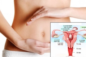 U xơ tử cung đặt vòng tránh thai có sao không?