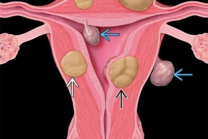 U xơ tử cung ở tuổi tiền mãn kinh: Nguyên nhân và cách điều trị