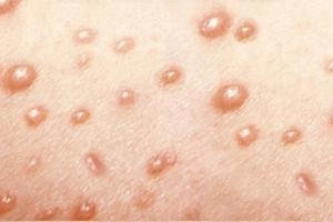 Uống nước chung với người thủy đậu có lây không?