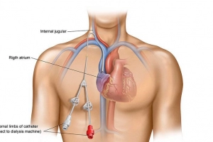 Ưu điểm của đặt catheter tĩnh mạch trung tâm dưới hướng dẫn siêu âm
