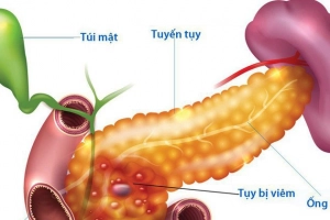 Vai trò của phản ứng miễn dịch bẩm sinh và xơ hóa storiform trong viêm tụy tự miễn ở người