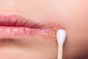Vết loét lạnh ở trẻ: Nguyên nhân