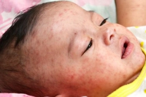 Vi khuẩn neisseria meningitidis gây viêm não mô cầu