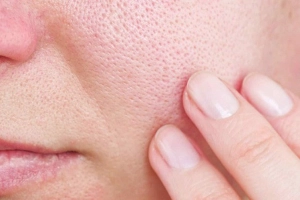 Vì sao khó trị dứt điểm mụn đầu đen và lỗ chân lông to?