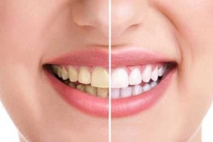 Vì sao răng bị đổi màu?