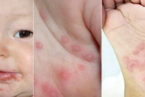 Vì sao tay chân miệng ở trẻ em lại nguy hiểm?