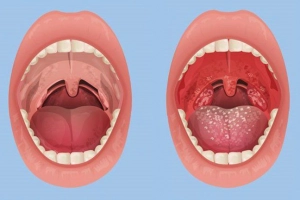 Viêm amidan kèm men gan cao điều trị thế nào?