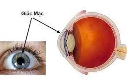 Viêm giác mạc dị ứng hay tái lại có điều trị dứt điểm không?