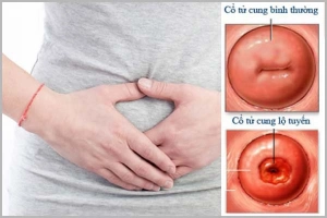 Viêm lộ tuyến cổ tử cung độ 2 có nên đốt không?