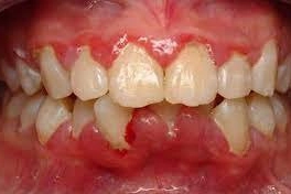 Viêm lợi trùm điều trị được không?