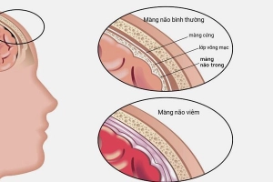 Viêm màng não có nguy hiểm không?