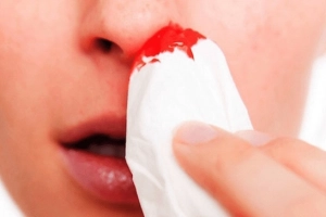 Viêm mũi dị ứng gây chảy máu mũi có sao không?