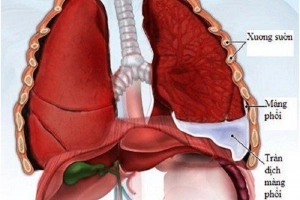 Viêm phổi cấp có thể tự khỏi không?