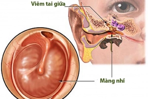 Viêm tai giữa mãn tính do thủng màng nhĩ
