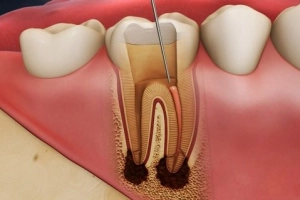 Viêm tủy răng bên trong phải điều trị thế nào?