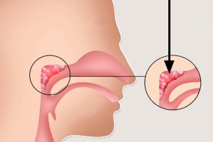 Viêm VA ở trẻ em có nguy hiểm không?