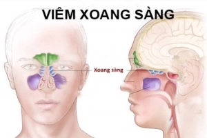 Viêm xoang sàng: Những điều cần biết