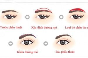 Vinmec có thực hiện treo cung lông mày không cho người sụp mí không?