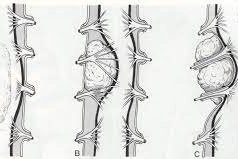 Vinmec thực hiện kỹ thuật nào chẩn đoán u màng ống nội tủy?