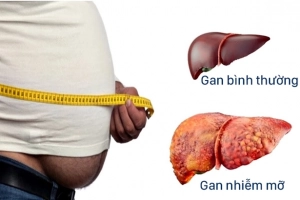 Xác định bệnh gan nhiễm mỡ không do rượu có nguy cơ tiến triển bệnh thận mãn tính