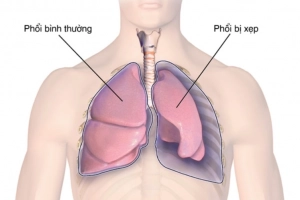 Xẹp phổi kèm khó thở phải làm sao?