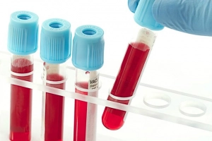 Xét nghiệm Ceruloplasmin: Ý nghĩa, chỉ định, cách thức thực hiện