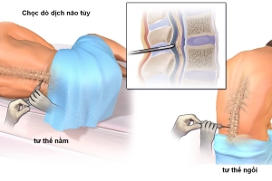 Xét nghiệm dịch não tủy (CSF)