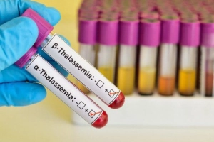 Xét nghiệm gì để biết bệnh Thalassemia?