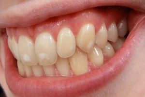 Xử lý đốm trắng trên răng thế nào?