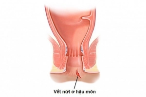 Xử trí cấp cứu vết thương hậu môn trực tràng