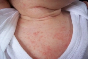 Xử trí khi trẻ bị rôm sảy ở cổ