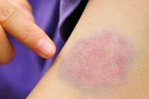 Xuất hiện vết bầm tím dưới da lâu ngày không khỏi có sao không?