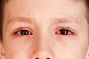 Xuất huyết dưới da quanh mắt có nguy hiểm?