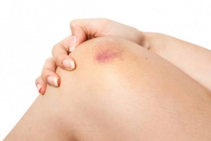 Xuất huyết dưới da: Vì sao không nên xem nhẹ?