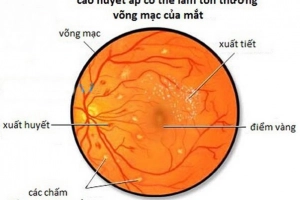 Xuất huyết võng mạc có để lại sẹo không?