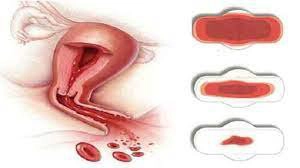 Điều trị dứt điểm rong kinh như thế nào?