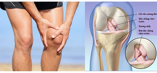 Tái tạo dây chằng chéo trước khớp gối
