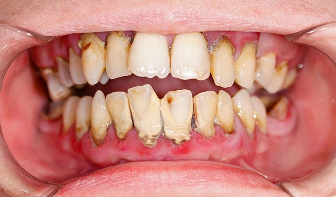 Nha chu là một trong các nguyên nhân hơi thở hôi