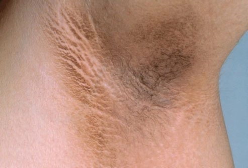 Acanthosis nigricans