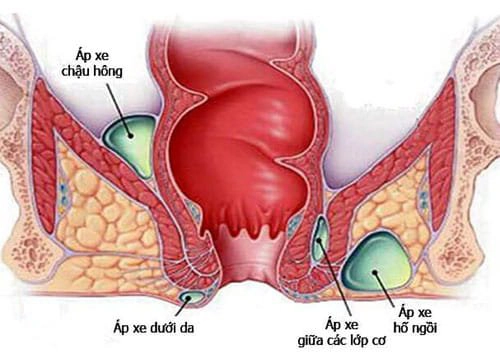 Áp xe hậu môn trực tràng