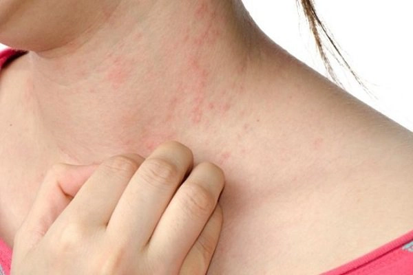 Vì sao có người bị dị ứng hải sản?