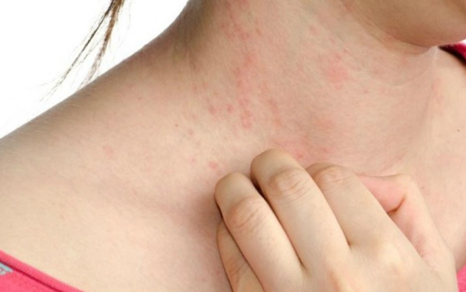 Ngứa khi sốt xuất huyết
