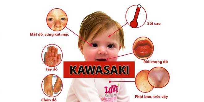 Biểu hiện bệnh Kawasaki